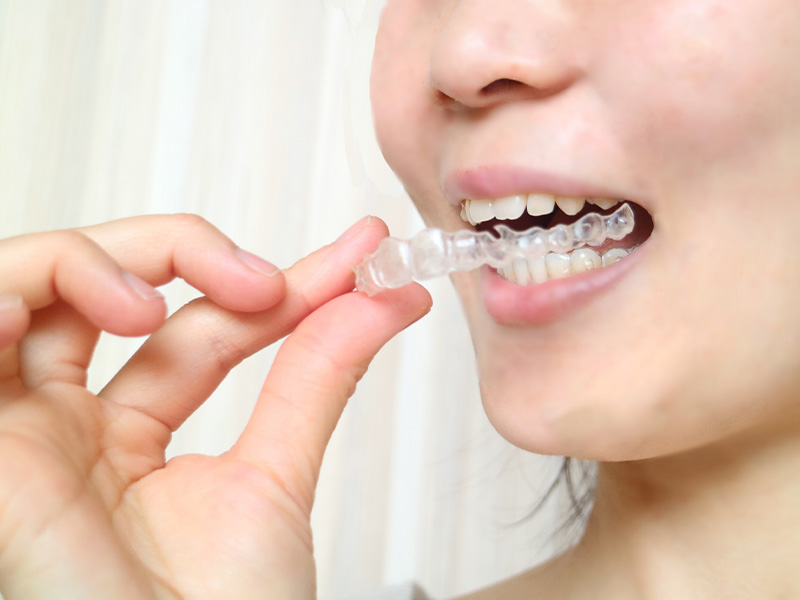 『invisalign』インビザライン矯正（マウスピース矯正）
